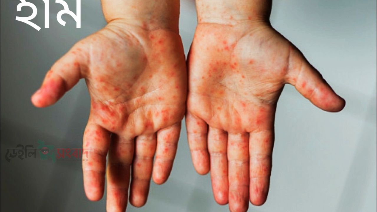 চাঁপাইনবাবগঞ্জে হামের টিকাদান প্রায় লক্ষ্যমাত্রা পূরণ, রোগী ১০১৭ জন