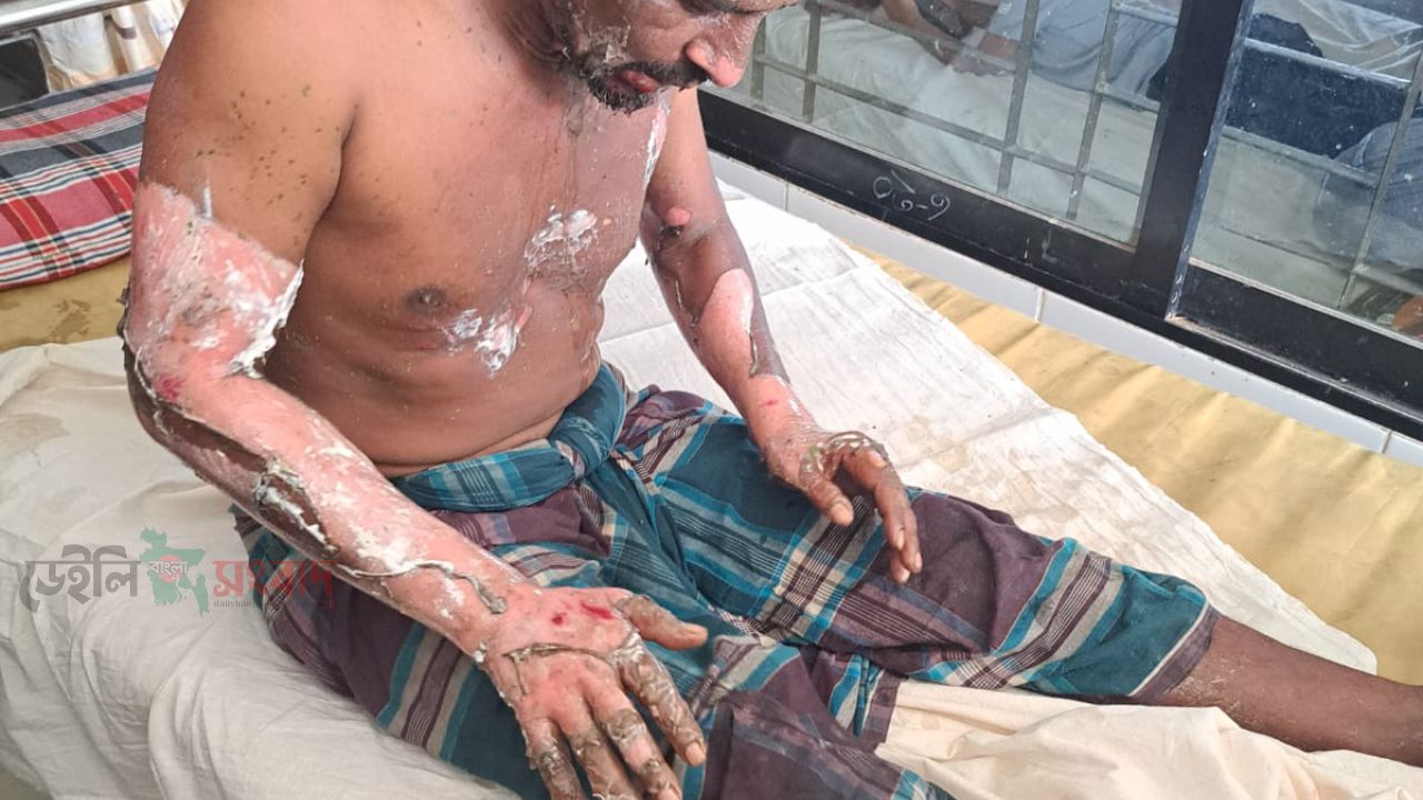 পেট্রোল ঢেলে শ্রমিক সর্দারকে পুড়িয়ে দেওয়ার অভিযোগ, রাজশাহী মেডিক্যালে চিকিৎসাধীন      